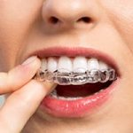 Brackets Esthétiques Orthodontique Orthodontie Transparente Invisalign pour Adulte