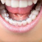 orthodontie linguale invisible une solution en toute discrétion