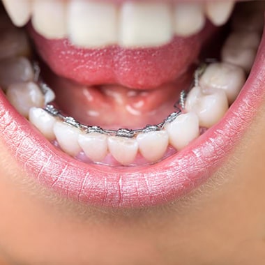 orthodontie linguale invisible une solution en toute discrétion